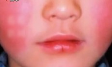 
        		日本“苹果病”流行达到历史顶点：从双颊开始形成网状红斑 !	